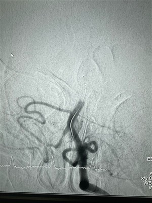 ドレッジャーステント回収機の新たな事例